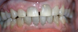 Tetracycline Bleaching and Crowns (Temporaries), Before Treatment